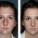 Glycolic hámlás (sav), hogyan kell csinálni otthon, ellenjavallatok (fotók előtt és után)