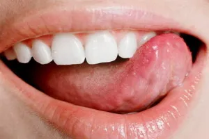 Glossalgia - kezelés, fotó, tünetei, hogyan kell kezelni glossalgia