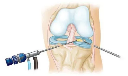 Osteoarthritis - ez gonartrózis 2, 3 fok a kezelés (a) Osteoarthritis - Mi ez gonartroz 2, 3-as fokozatú kezelés