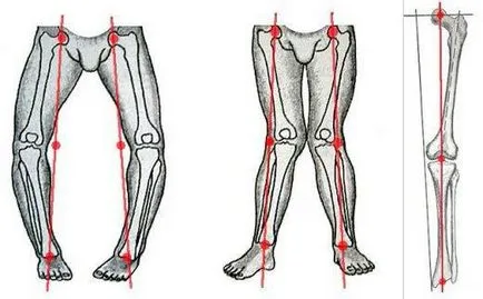 Osteoarthritis - ez gonartrózis 2, 3 fok kúra (fok gonartrózis kezelés) Osteoarthritis - Mi ez gonartroz 2, 3-as fokozatú kezelés