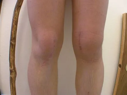 Gonarthrosis, mi az, és annak típusai, tünetei és kezelési módszerek (közös) Gonarthrosis, mi az, és annak típusai, tünetei és kezelések