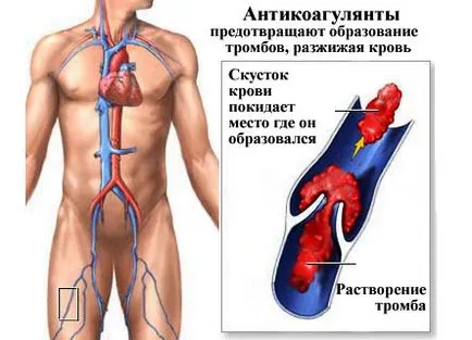 Ischaemiás stroke-ot kezelésére és megelőzésére, gyógyszerek (ischaemiás stroke kezelésére szolgáló szert antikoaguláns gyógyszerek tünetek) Ischaemiás stroke-ot kezelésére és megelőzésére, gyógyszerek