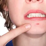 Hogyan lehet gyorsan távolítsa el a pattanások a homlokán néhány tipp a bőrgyógyász számára (a gyorsan távolítsa el a pattanások) Hogyan lehet gyorsan távolítsa el a pattanások a homlokán néhány tipp a bőrgyógyász az Ön számára
