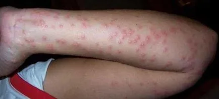 Csakúgy, mint, mint kezelésére csípésével poloska az emberi test a legjobb eszköz (marás) Valamint, mint kezelni a csípése poloska az emberi test a legjobb eszköz