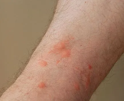 Csakúgy, mint, mint kezelésére csípésével poloska az emberi test a legjobb eszköz a (kezelt) Valamint, mint kezelni a csípése poloska az emberi test a legjobb eszköz