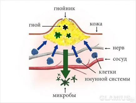 Hogyan lehet megszabadulni a sorja - Sorjázza