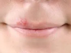 Hogyan kell kezelni a megfázás és a kenet az ajak, az orvosi tanácsot (kezelt) Hogyan kell kezelni a megfázás és a kenet az ajak, az orvosi tanácsot