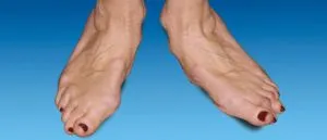 Hogyan kell kezelni osteoarthritis a láb otthon és hagyományosan, fotó patológia (kezelés arthrosis a láb) Hogyan kell kezelni osteoarthritis a láb otthon és hagyományosan, fotó patológia