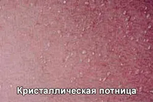 Hogyan lehet gyógyítani malária baba (fotó) (hogyan kell kezelni a malária újszülöttek) Hogyan lehet gyógyítani malária baba (fotók)