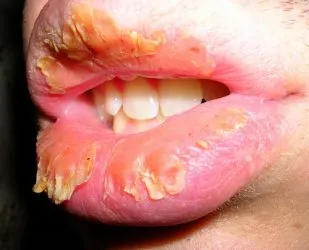 Hogyan kell kezelni cheilitis az ajkak az okok és a betegség tüneteit (cheilitis) Hogyan kell kezelni cheilitis az ajkak az okok és a betegség tünetei