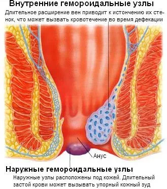 Hogyan kell kezelni a külső aranyér népi jogorvoslati otthon