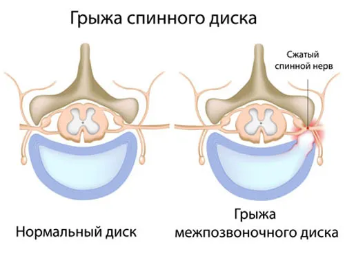 Hogyan kell kezelni porckorong sérv otthon