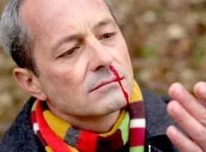 Hogyan lehet megállítani az orrvérzés egy felnőtt otthon, mit kell tennie (stop) Hogyan lehet megállítani az orrvérzés egy felnőtt otthon, mit kell tenni