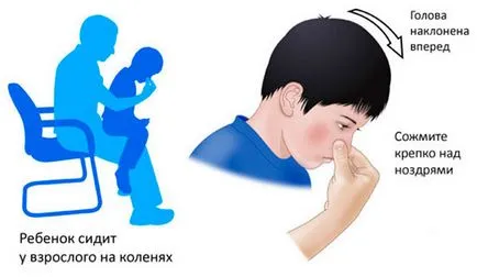 Hogyan lehet megállítani orrvérzés elsősegély, mit kell tenni