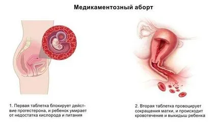 Hogyan készítsünk egy vetélés a terhesség alatt (vetélés) Hogyan készítsünk egy vetélés a terhesség alatt