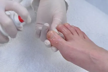 Hogyan lehet eltávolítani a köröm a finger otthon, szép körmök - kiegészíti a képet (eltávolították a köröm, ha felnő) Hogyan lehet eltávolítani a köröm a finger otthon, szép körmök - kiegészíti a képet
