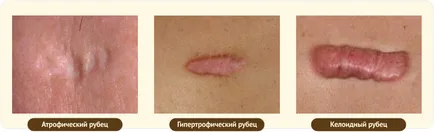 Hogyan lehet eltávolítani a hegesedés a pattanások és mitesszerek az arcon és áttekintést ártalmatlanítási módszerek