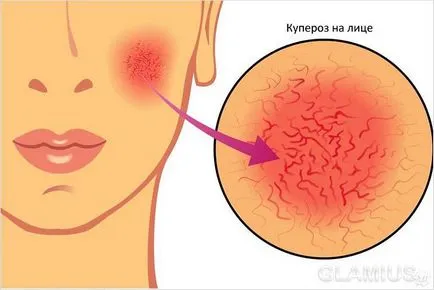 Hogyan lehet eltávolítani a seprűvénák - küzd érrendszeri háló (Vascular csillag láb) Hogyan lehet eltávolítani a seprűvénák - küzdő érrendszeri net