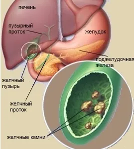 Az epekövek a máj tünetek, hogyan lehet megszabadulni és a kezelés