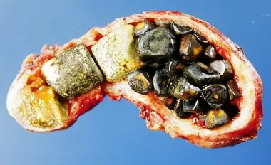 Az epekövek a máj tünetek, hogyan lehet megszabadulni és a kezelés