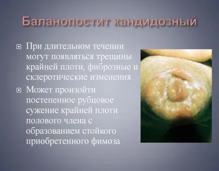 Candida balanoposthitis férfiaknál okoz, tünetek, kezelés, fotó (candida balanoposthitis) Candida balanoposthitis férfiaknál okoz, tünetek, kezelés, fotók