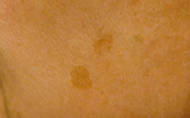 Barna foltok a bőrön kép, szövődmények, kezelés, növedékek a bőrön