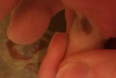 Barna foltok a bőrön kép, szövődmények, kezelés, növedékek a bőrön