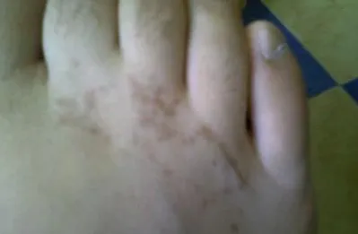 Barna foltok a bőrön kép, szövődmények, kezelés, növedékek a bőrön