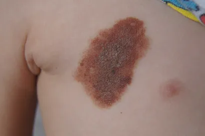 Barna foltok a bőrön kép, szövődmények, kezelés, növedékek a bőrön