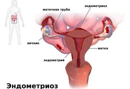 Barna mentesítés a menstruáció után egy héttel - mi ez