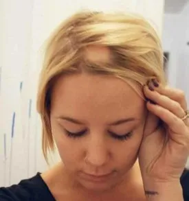 Krioterápia haj például a folyékony nitrogénnel befolyásolja, hogy az eljárás és kezelés (krioterápia hajra) Krioterápia haj, mint folyékony nitrogén befolyásolja, hogy az eljárás és a kezelés