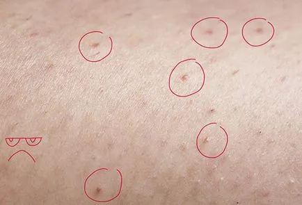 Piros pöttyök a lábán -, hogyan kell megszabadulni tőlük