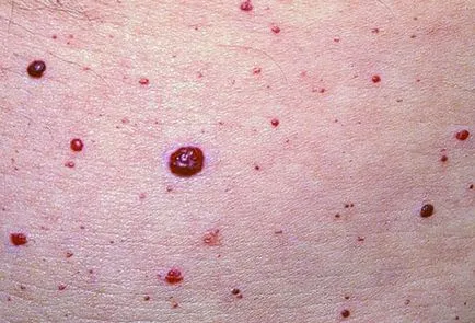 Piros pöttyök a lábán -, hogyan kell megszabadulni tőlük