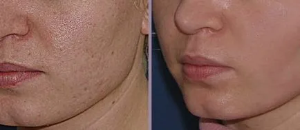 Laser arc hámlani kezd, mi ez, amint az gyakran történik, ellenjavallatok (peeling) Laser arc hámlani kezd, mi ez, amint az gyakran történik, ellenjavallatok