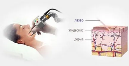 Laser arc hámlani kezd, mi ez, amint az gyakran történik, ellenjavallatok (peeling) Laser arc hámlani kezd, mi ez, amint az gyakran történik, ellenjavallatok