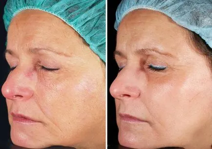 Arc Laser peeling - a leírás, ellenjavallatok, fotó, vélemények, árak (ellenjavallatok) Laser arc hámlani kezd - a leírás, ellenjavallatok, fotó, vélemények, árak