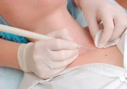 Lipoma - kezelés