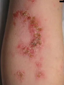 A kezelés a Staphylococcus aureus hagyományos módszerek