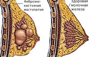 A kezelés népi jogorvoslati emlő nodális emlőbántalmak, diffúz és a cisztás fibrózisos (mastitis) A kezelés népi jogorvoslati emlő nodális emlőbántalmak, diffúz és fibrocisztás