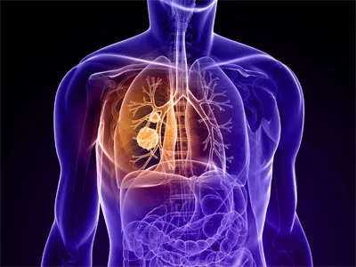 Kezelése tüdőtágulás segítségével népi jogorvoslati (emphysema) Kezelése tüdőtágulás használó emberek jogorvoslatok