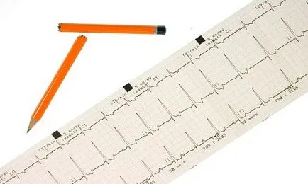Kezelése tachycardia népi jogorvoslati az otthoni (népszerűbb) tachycardia kezelése népi jogorvoslati otthon