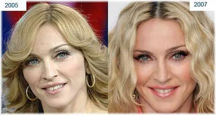 Madonna plasztikai sebészet fotók előtt és után