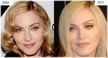 Madonna plasztikai sebészet fotók előtt és után