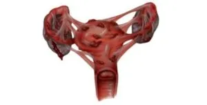 Miómák és endometriózis kezelésére, a tünetek és a kezelés (endometriózis) Miómák és endometriózis tünetei és kezelése