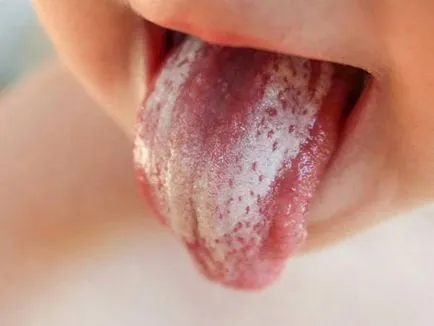 Stomatitis kenőcs gyermekek válogatás a legjobb alapok (gyermek) Stomatitis kenőcs gyermekek válogatás a legjobb alapokat