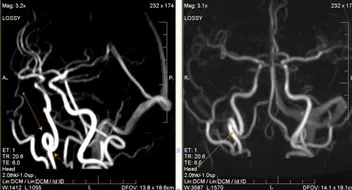 MRI szakértő, MR angiográfia a tanulmány agyi artériák
