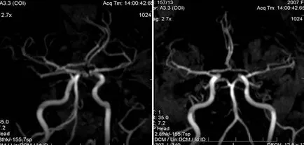 MRI szakértő, MR angiográfia a tanulmány agyi artériák