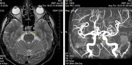 MRI szakértő, MR angiográfia a tanulmány agyi artériák