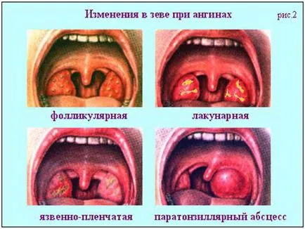 Függetlenül attól, hogy lehetséges, hogy a hő a torok gennyes angina só, sál, inhalációs, borogatást (akár meleg torok angina só) Függetlenül attól, hogy lehet fűteni a torok gennyes angina só, sál, inhaláció, borogatások