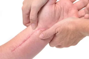 Folk jogorvoslati hegek a felbontás és kisimítja a bőrt